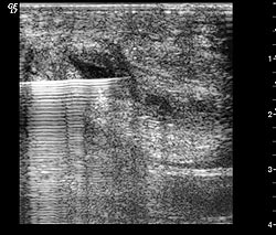 Needle Inserted Into Lesion Using Ultrasound Guidance